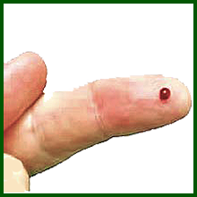 How to use HIV Home Kit rapid HIV instant test kits 5:  Wait until a large drop of blood forms - gently pressing each side of the finger will help